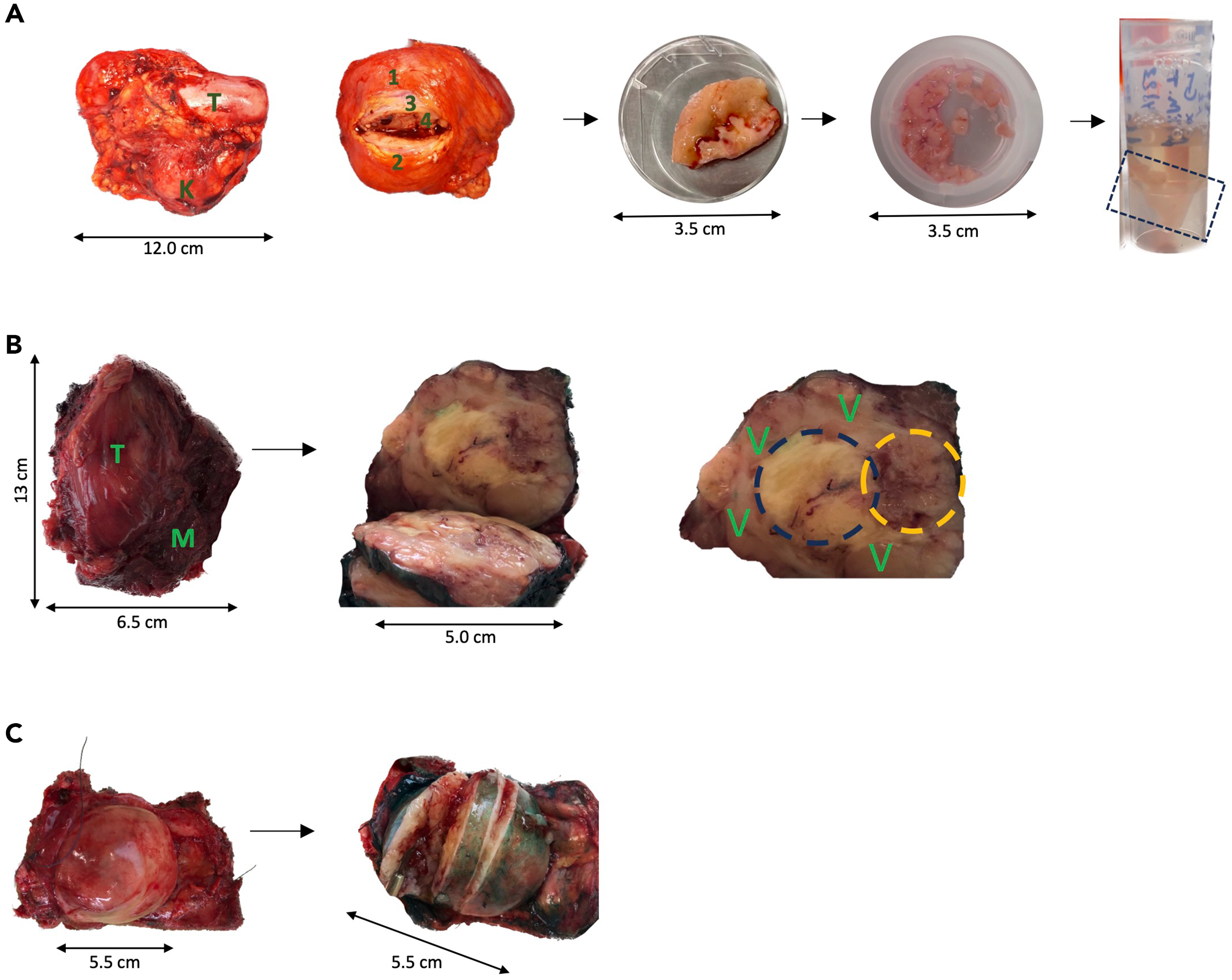 Generation of post-surgical minimal residual disease models to